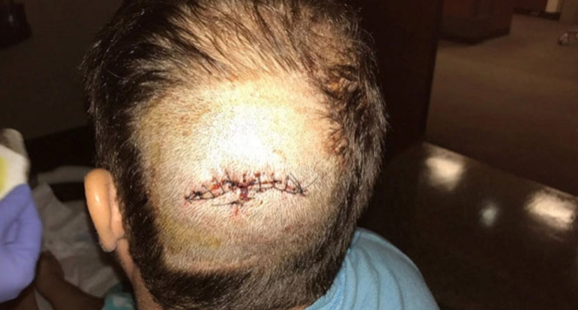 Brutal Golf Club Assault Leaves Man Severely Injured